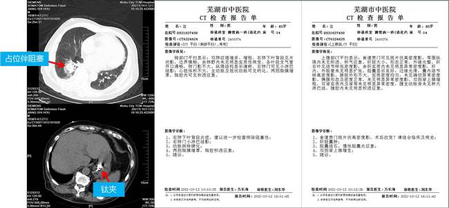 小鈦夾，威力大 ——記一例上消化道大出血患者的救治經(jīng)過(圖2)