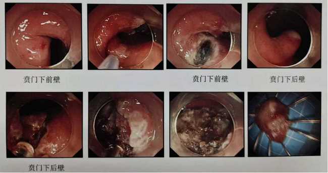 炎夏漸至，“胃腸”已碌 ——狹小的空間見證消化內(nèi)鏡微創(chuàng)手術(shù)的魅力(圖2)