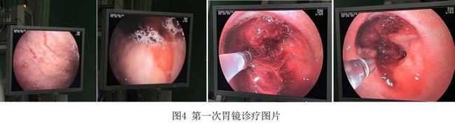 癡呆老人命懸一線，內(nèi)鏡止血彰顯奇功(圖2)