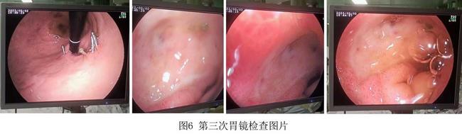 癡呆老人命懸一線，內(nèi)鏡止血彰顯奇功(圖4)
