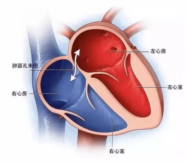 探尋不明原因卒中、偏頭痛根源的檢查技術(shù)—TCD發(fā)泡試驗(圖1)
