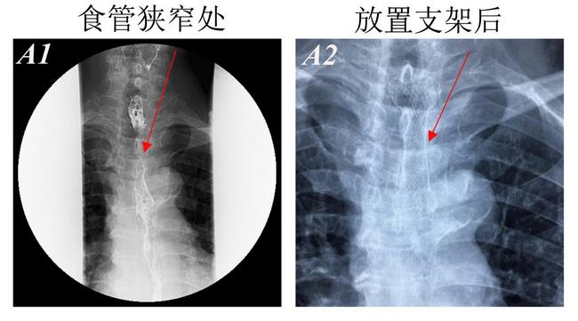 消化科運用多學科會診（MDT）微創(chuàng)診治食管惡性腫瘤侵潤所致食、氣道梗阻(圖4)